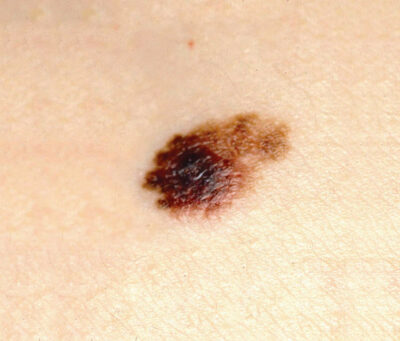 Checking Your Skin - Melanoma Institute Australia