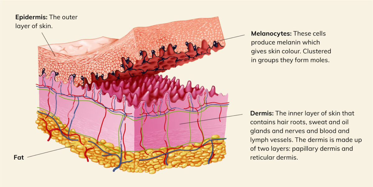 What is Melanoma? Melanoma Institute Australia